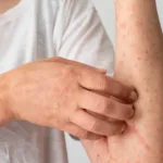 Mpox: Penyakit Lama yang Harus Diwaspadai | Warna Muda Media